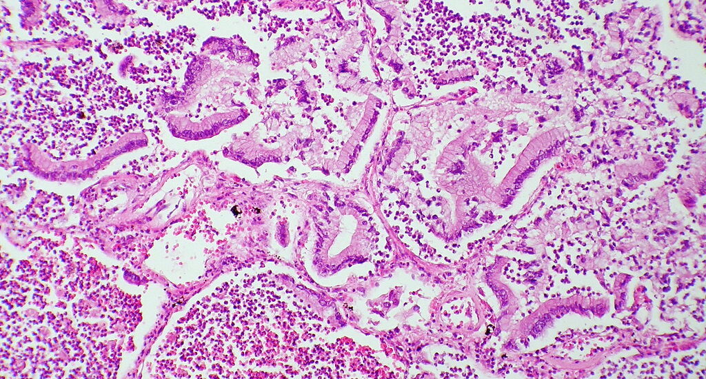 tumore pancreas