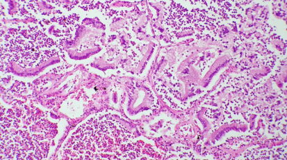 tumore pancreas