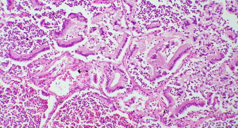 tumore pancreas