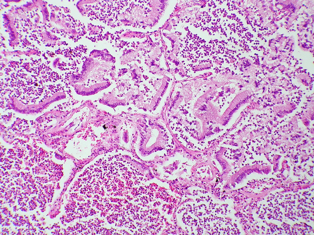 tumore pancreas