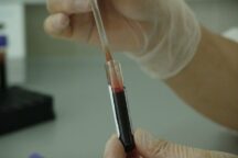 Plasma Covid-19 Test Sierologici