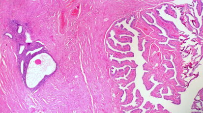 endometriosi