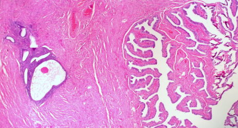 endometriosi