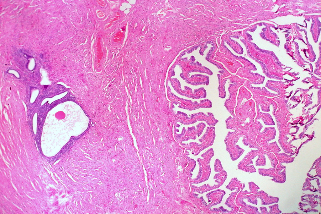 endometriosi