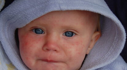 morbillo