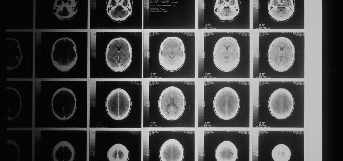 Raggi X Malattie Neurodegenerative