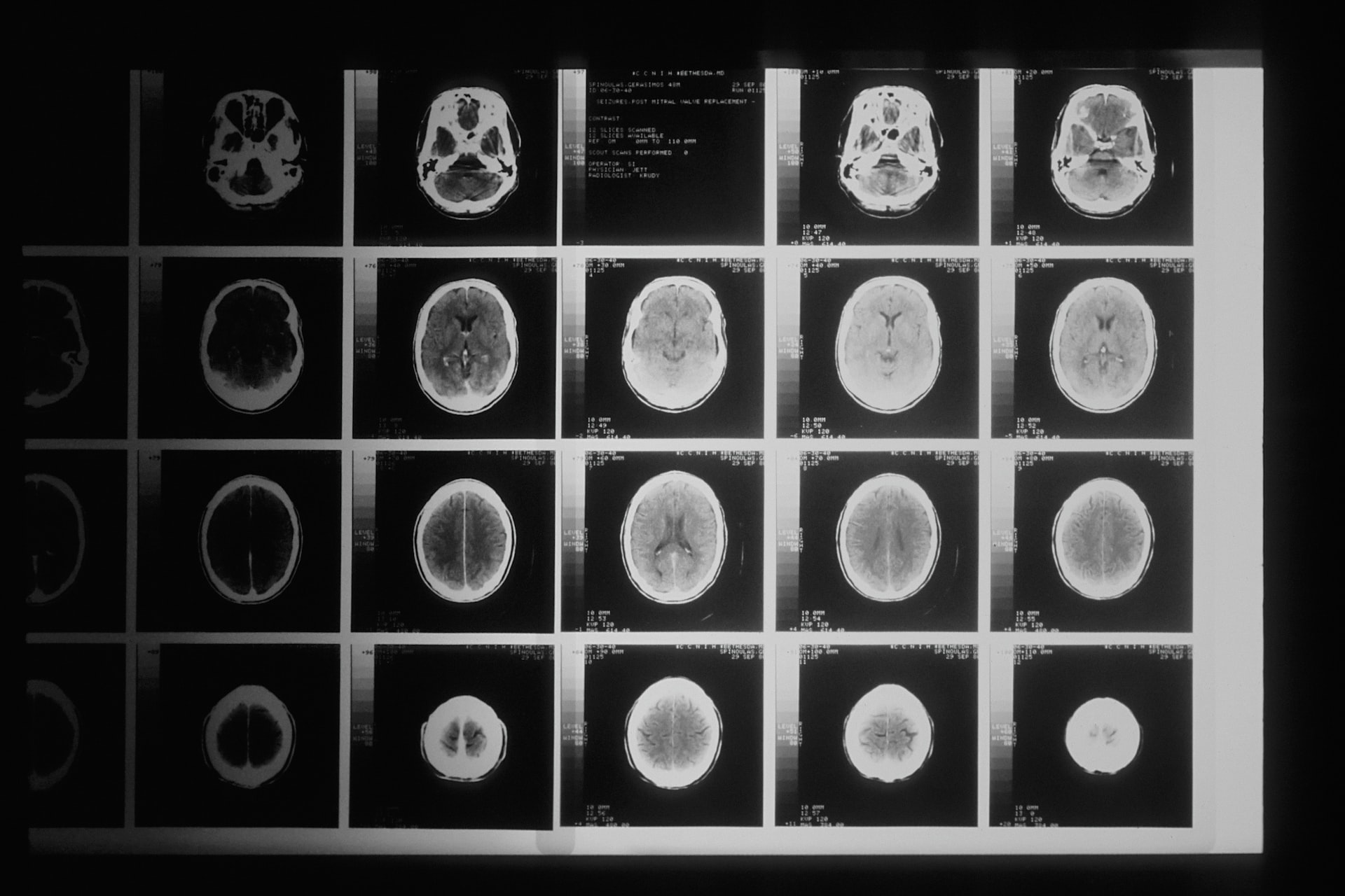 Here's how X-rays can help us understand neurodegenerative diseases