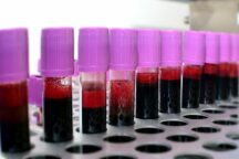 Plasma Diasorin Technogenetics Coronavirus Covid-19 Test Sierologici Governo