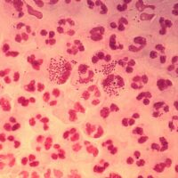 gonorrea
