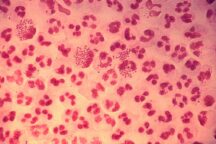 Gonorrea