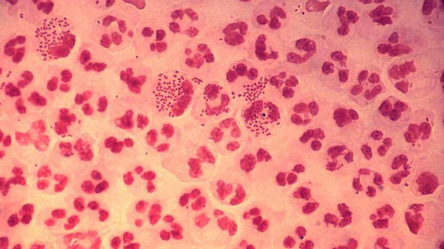 Gonorrea